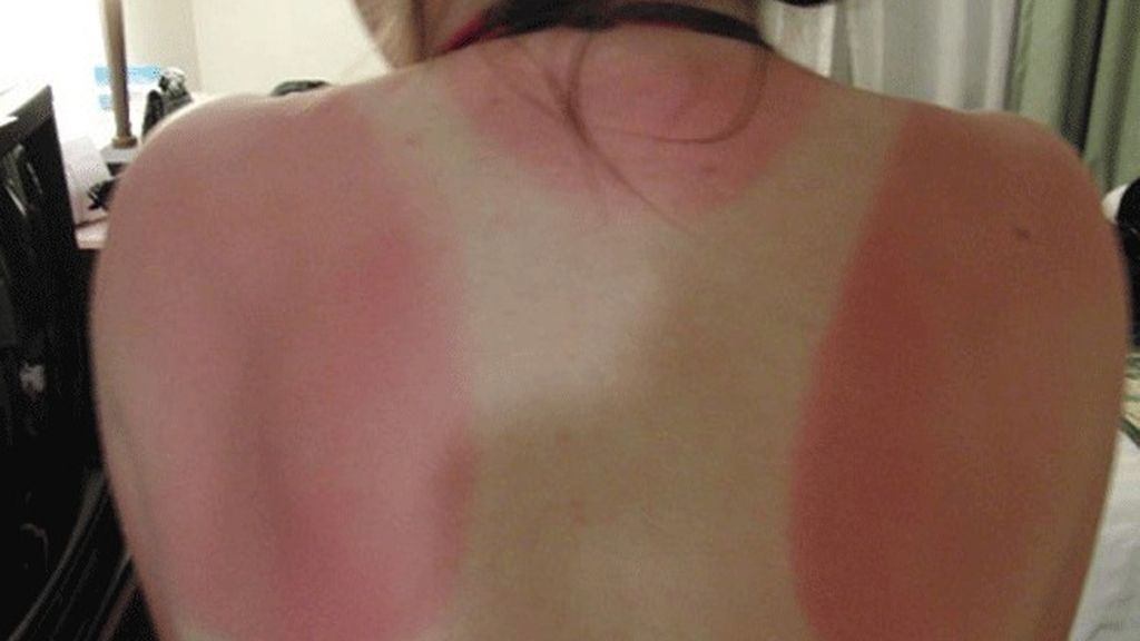 Cuando el sol te marca