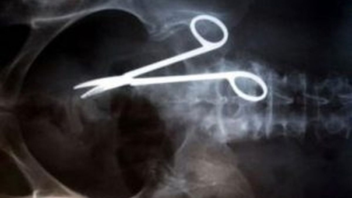 Una brasileña vivió durante dos años con unas tijeras de 18 centímetros que fueron dejadas dentro de su vientre después de ser sometida en 2008 a una operación quirúrgica. Foto canal TV O'Globo
