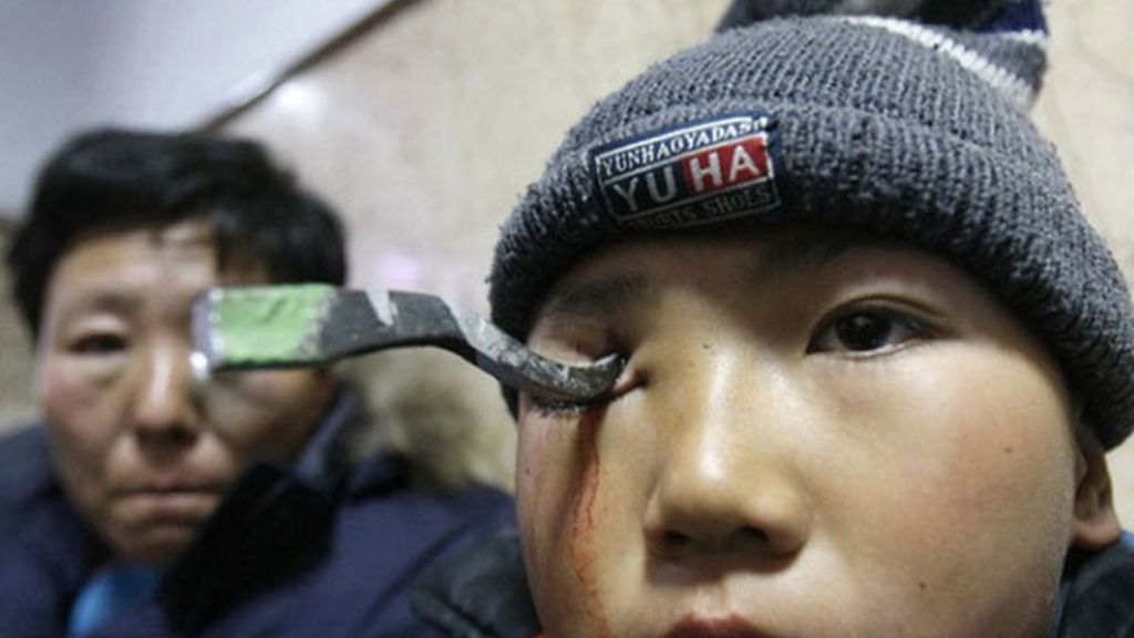 Se clava un gancho en un ojo