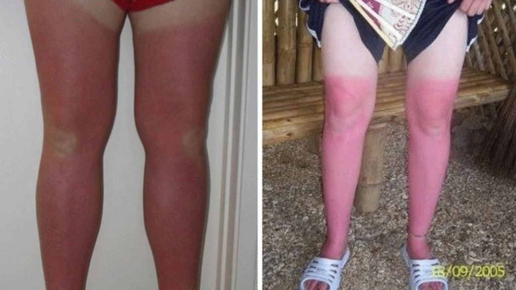 Cuando el sol te marca