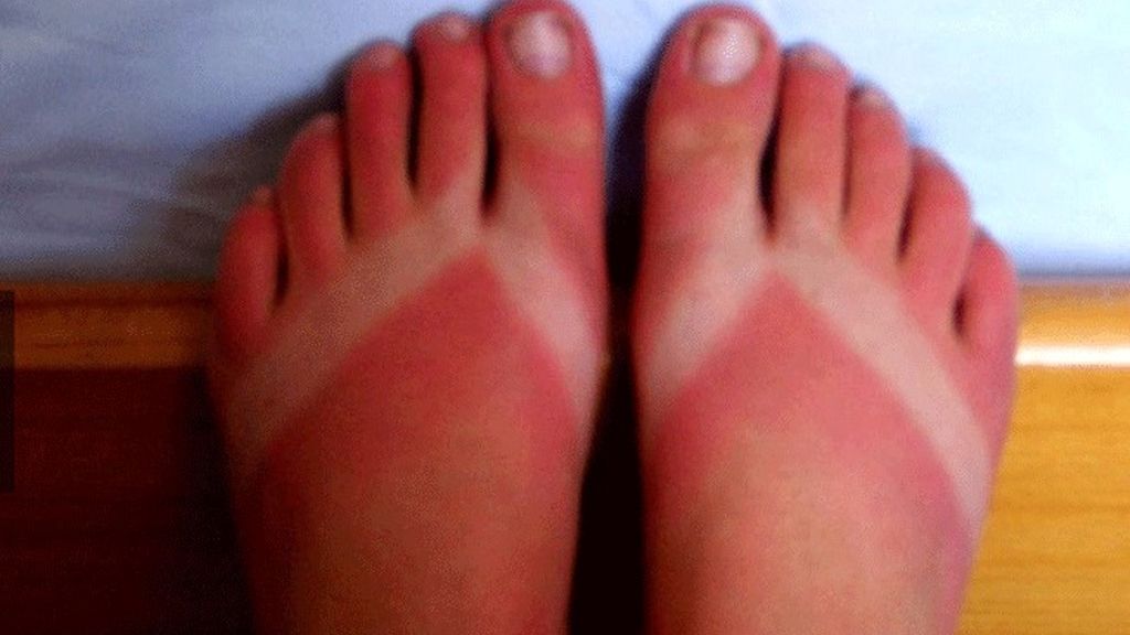 Cuando el sol te marca