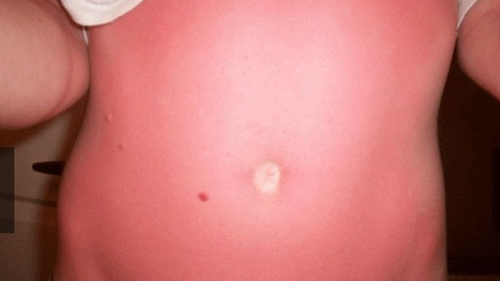 Cuando el sol te marca