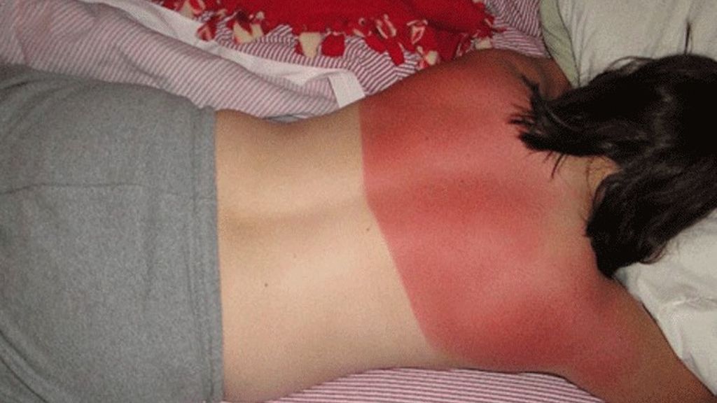 Cuando el sol te marca