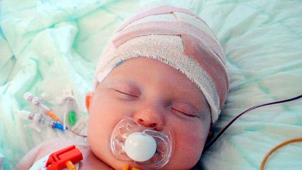 La 'niña milagro' a la que abrieron el cráneo para salvarla