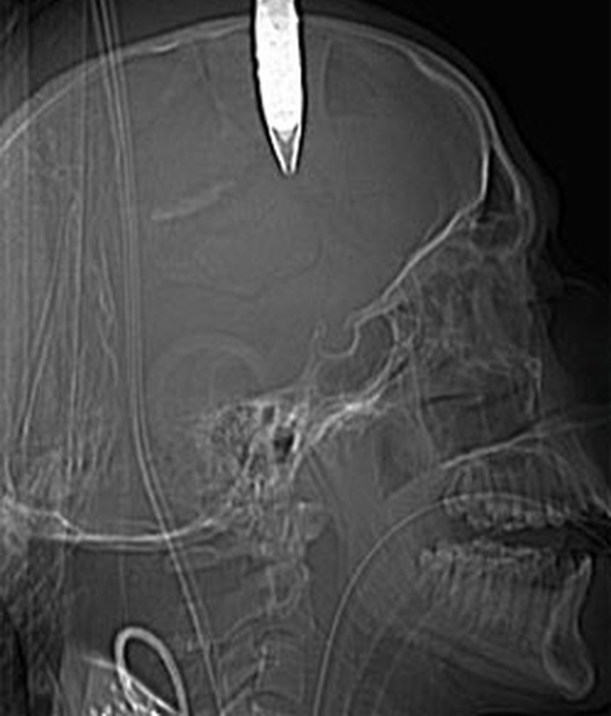 Radiografía del soldado con la bala en el cerebro. Foto: The Sun