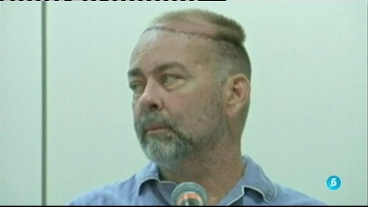 Un hombre se somete al primer trasplante de cráneo y cuero cabelludo