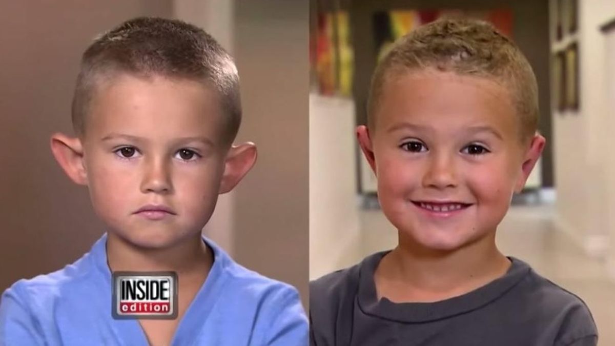 Un niño de seis años se somete a cirugía plástica para corregir sus "orejas de elfo"