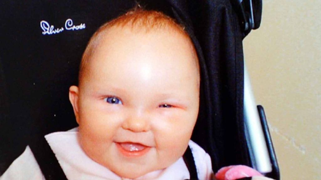 La 'niña milagro' a la que abrieron el cráneo para salvarla