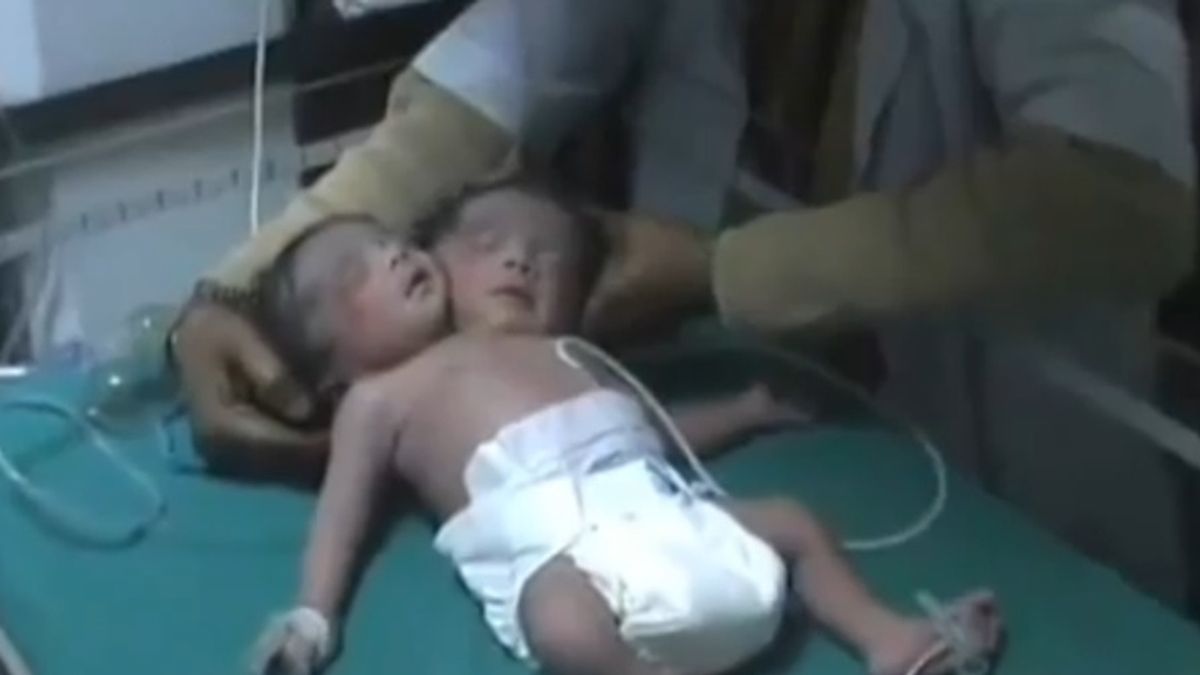 Nace una niña con dos cabezas en la India