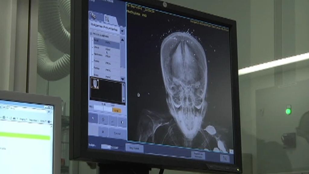 Los forenses analizan la momia del general Prim