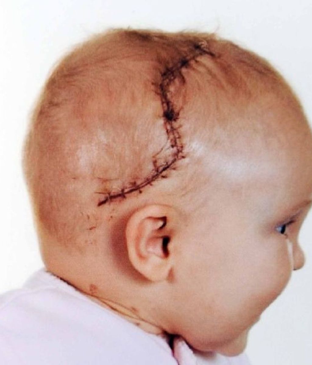 La 'niña milagro' a la que abrieron el cráneo para salvarla
