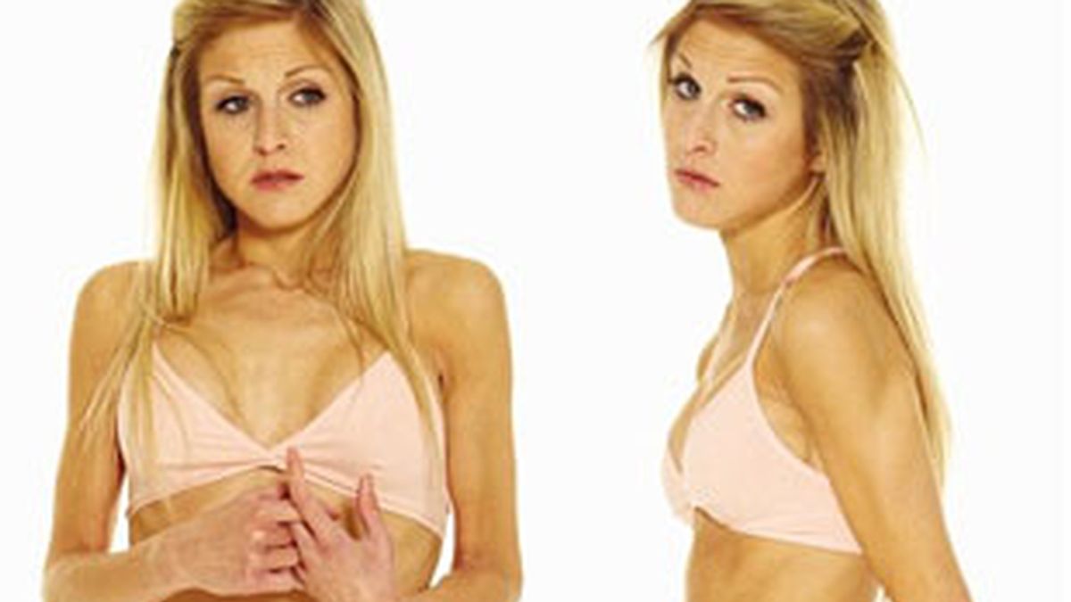 Nikki Grahame, una ex concursante del Gran Hermano británico, sufre anorexia. Foto: Daily Mail.