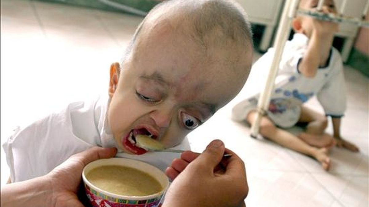 Una enfermera que da de comer a Cao Thi Lan Phuong, cuando tenía de 5 años, que sufre desde que nació los efectos presuntamente producidos por el "Agente Naranja", en un Hospital de Obstetricia y Ginecología de Ho Chi Minh (Vietnam). Fotografía del 28 de abril de 2005. EFE/Archivo
