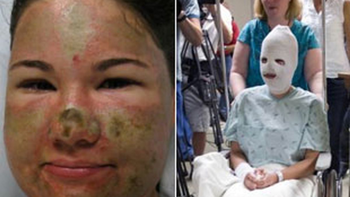 Imágenes de archivo de Bethany Storro tras haberse arrojado ácido en la cara. Fotos: AP.