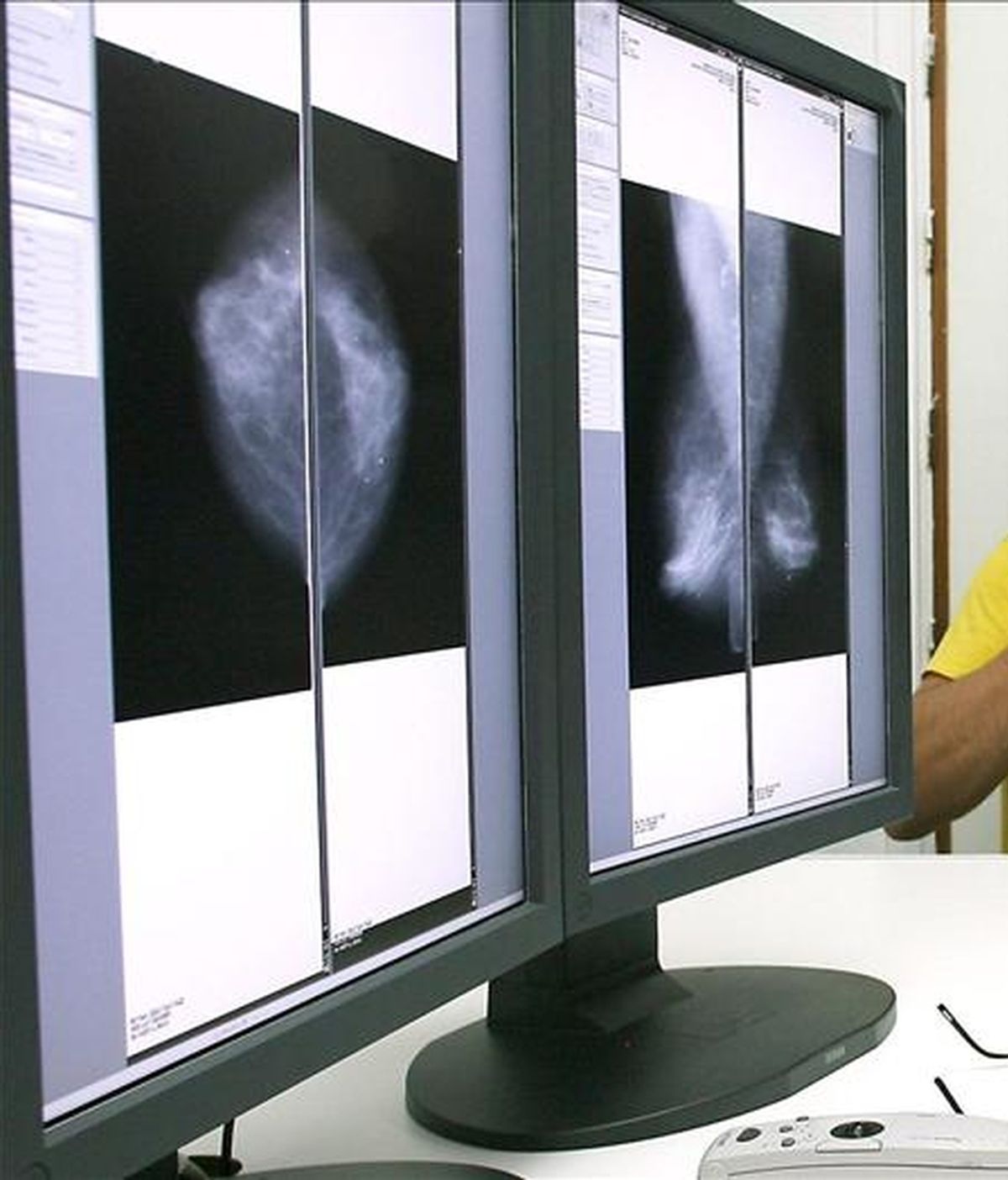 En la imagen, una mamografía a través de la digitalización. EFE/Archivo