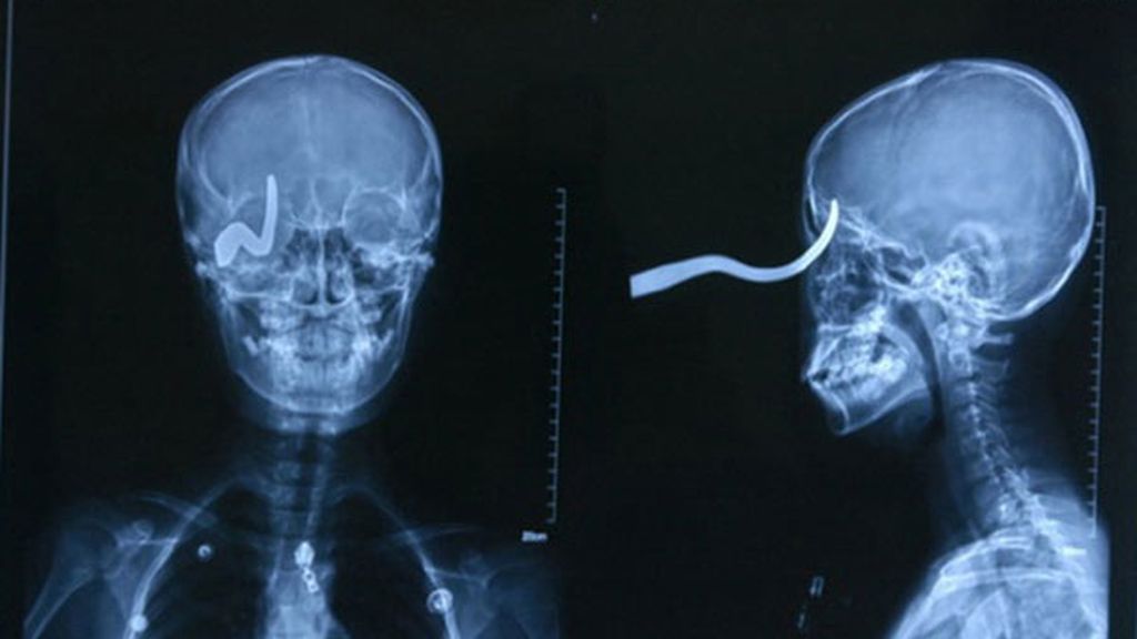 Se clava un gancho en un ojo