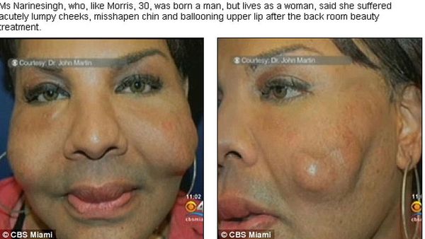El falso cirujano de Miami también inyectó cemento en la cara a una ...