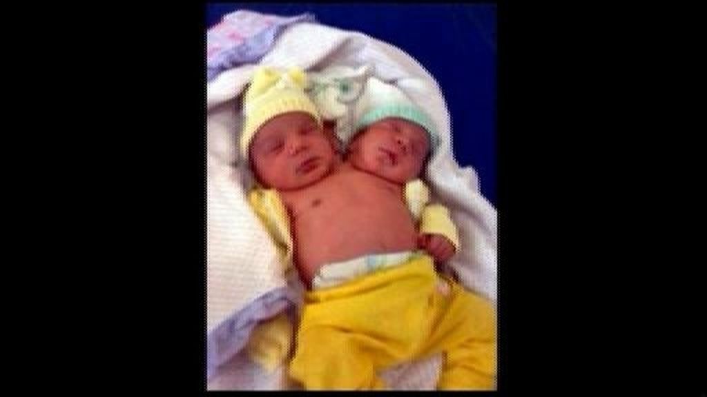 Nace un niño con dos cabezas en Brasil