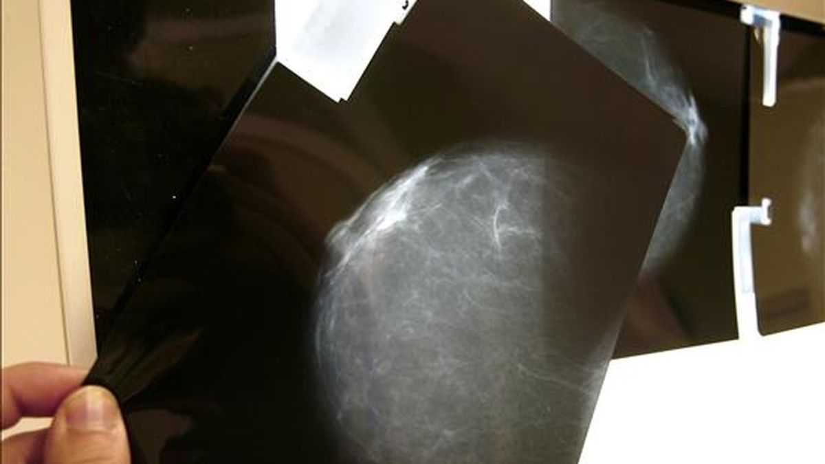 Fotografía de archivo, tomada en Bilbao el 07-02-07, de una prueba radiológica de mama. EFE/Archivo