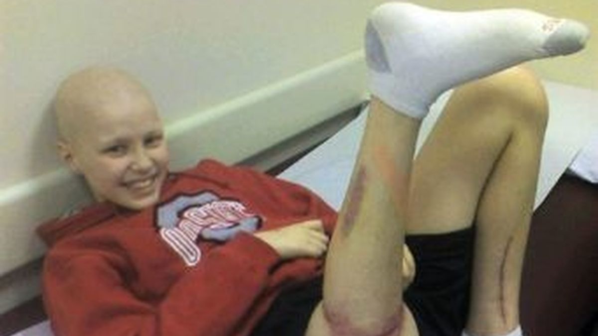 Dugan Smith de 13 años sufría un osteosarcoma y esta solución le ha permitido seguir haciendo su vida normal. Foto Yahoo News Canadá