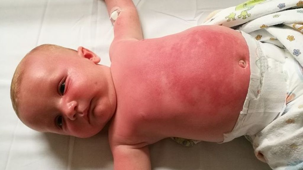 Hospitalizan a un bebé tras aplicarle una crema de Peppa Pig Hospitalizan a un bebé tras aplicarle una crema de Peppa Pig