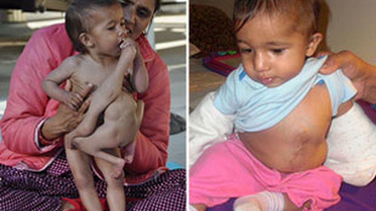 Rishabh nació con un hermano gemelo que no terminó de formarse pegado al torso. Foto: The Sun