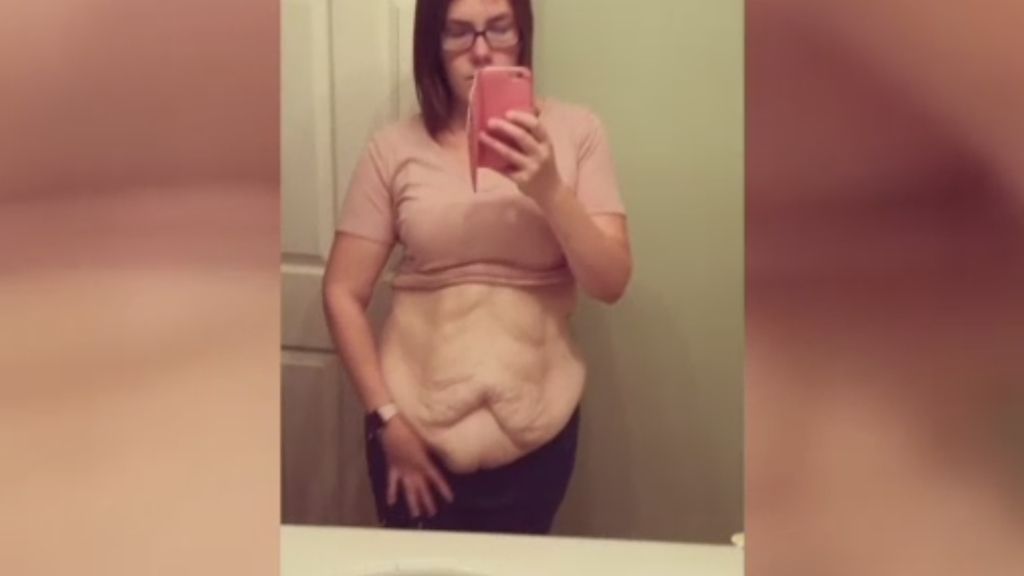 Una mujer muestra sin complejos toda la piel sobrante tras adelgazar 68 kilos