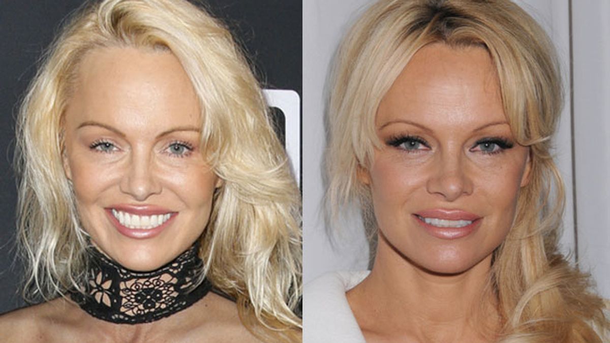 Pamela Anderson, cirugía estética Pamela Anderson