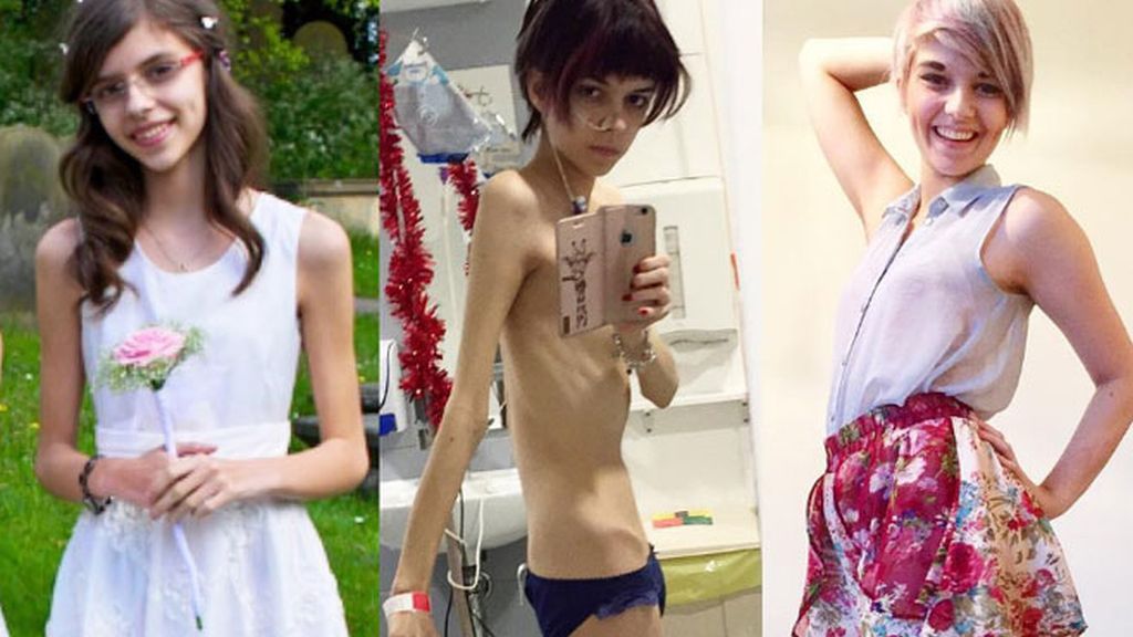 Vence a la anorexia y muestra su evolución en Instagram