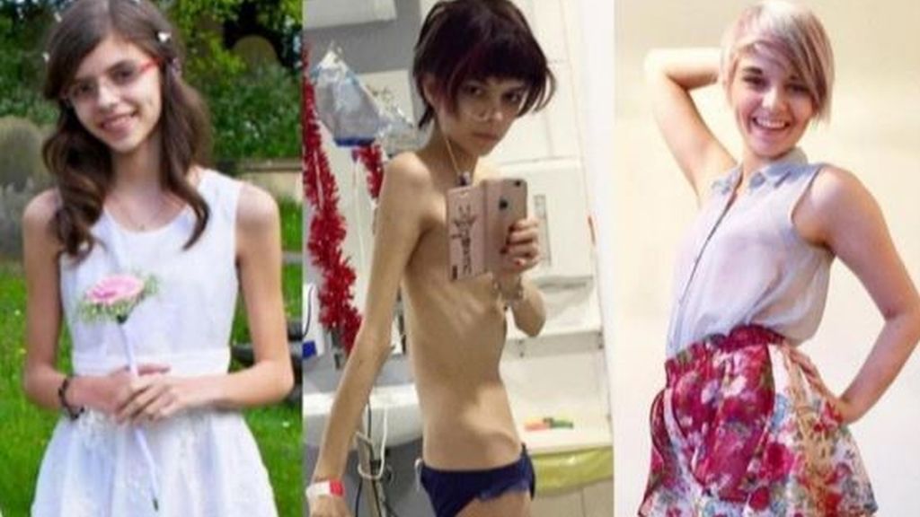 Muestra en Instagram su victoria a la anorexia