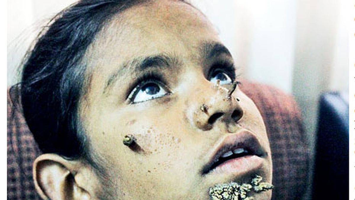 niña árbol, hombre árbol, Abul Bajandar, Shahana niña árbol, hombre árbol, Abul Bajandar, Shahana