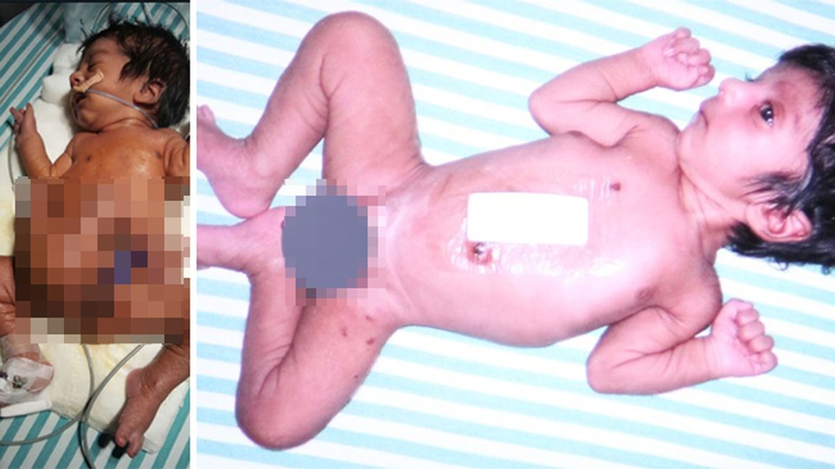 Operan con éxito a un bebé que nació con cuatro piernas y dos penes en la India