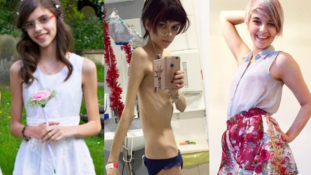 Joven muestra su cambio tras sufrir anorexia