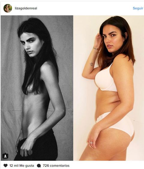 anorexia antes y despues