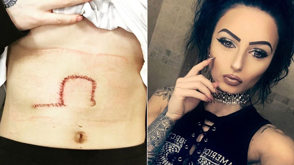 Se hace un selfi en bikini y descubre que tiene un agresivo cáncer de piel Se hace un selfi en bikini y descubre que tiene un agresivo cáncer de piel