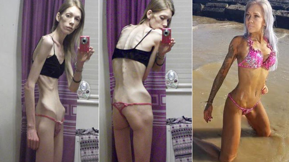 De estar al borde de la muerte por su anorexia a campeona de levantamiento de peso