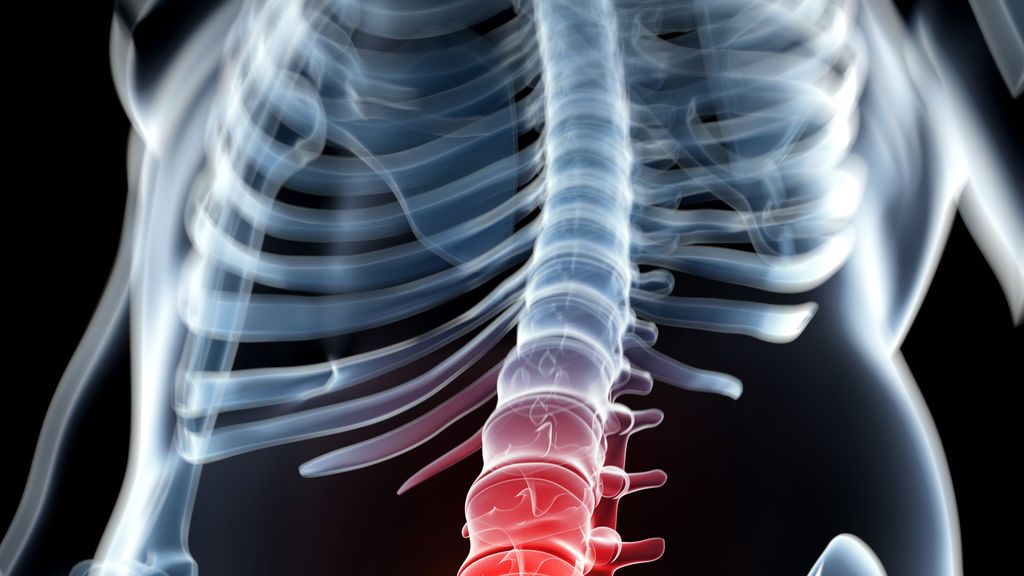 Paralítico logra caminar después de implantarle un dispositivo en la médula ósea