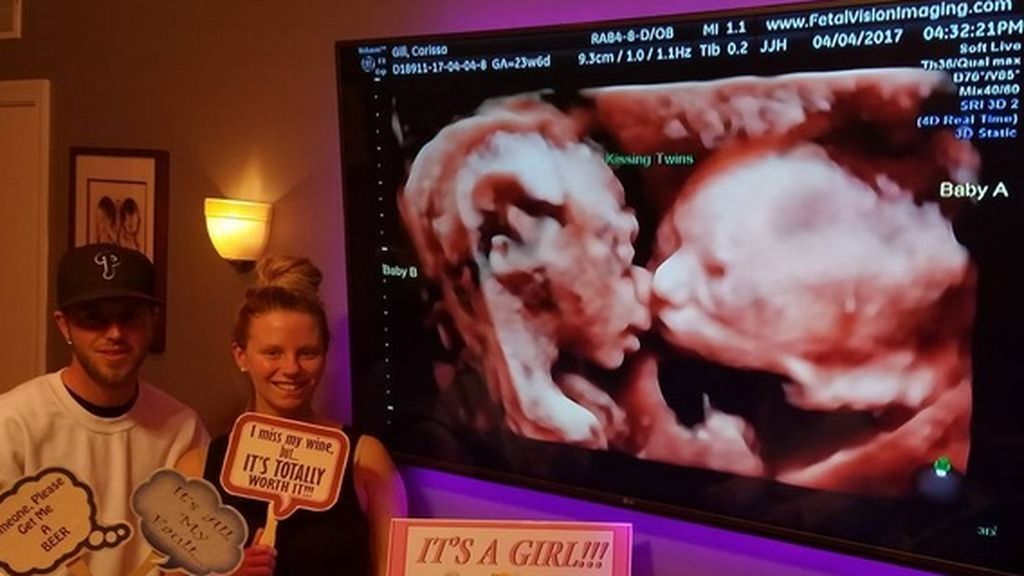 Una ecografía 4D muestra a dos gemelas dándose un beso en la tripa de su madre