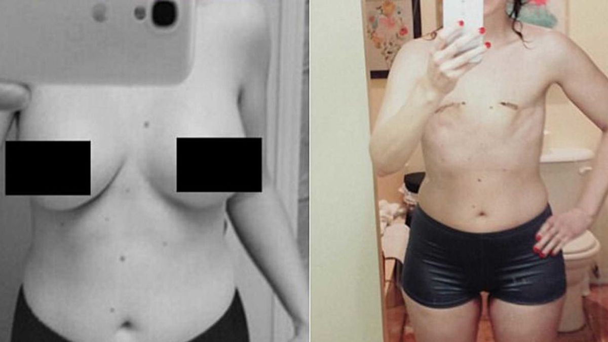 Muestra valiente las cicatrices de su mastectomía:"Es increíblemente extraño sentir sus costillas directamente” Muestra valiente las cicatrices de su mastectomía:"Es increíblemente extraño sentir sus costillas directamente”