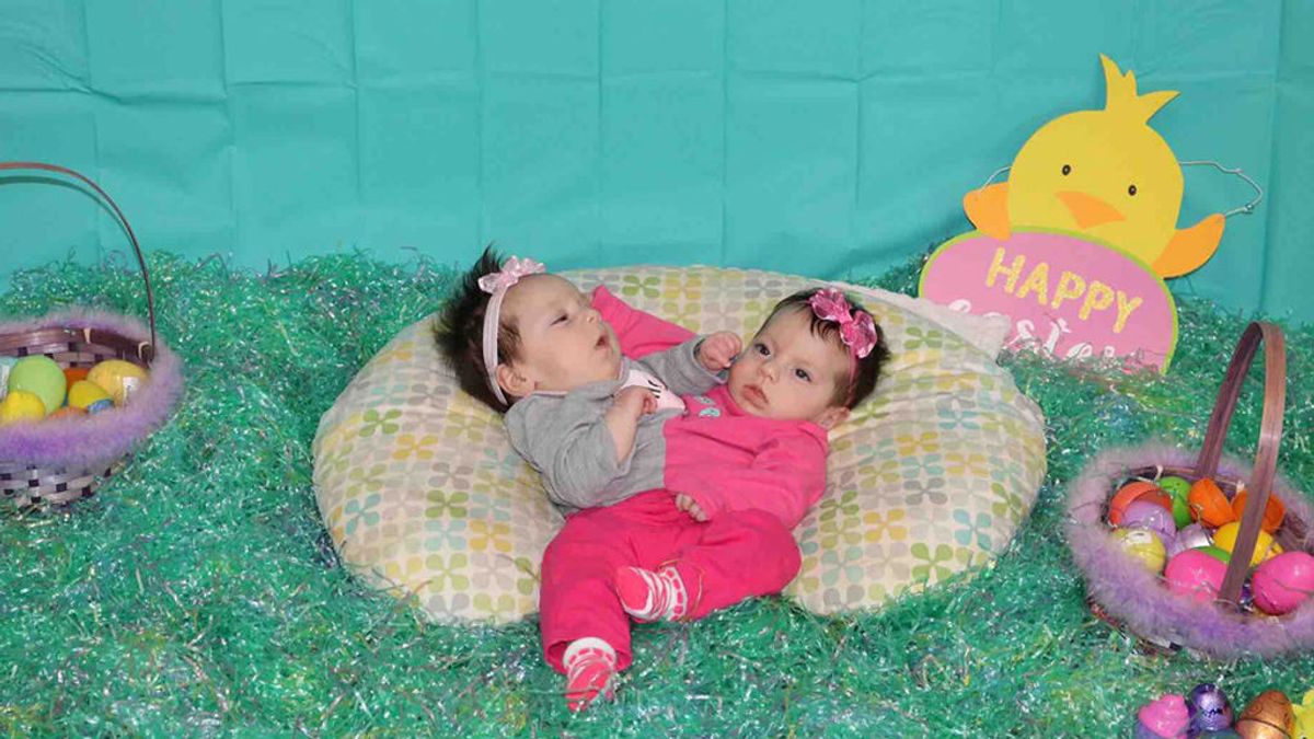 Así lucen las pequeñas gemelas siamesas, después de que los médicos aconsejaran que abortara