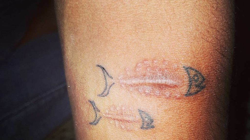 Un par de peces nacen de estas dos cicatrices en el brazo