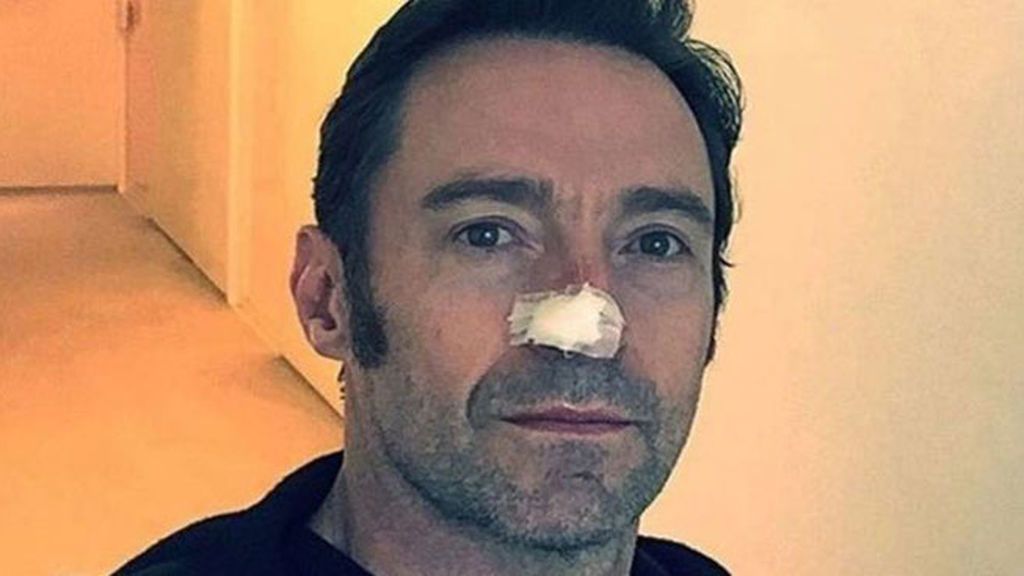 Hugh Jackman tiene cáncer de piel: un oncólogo nos dice cómo protegernos