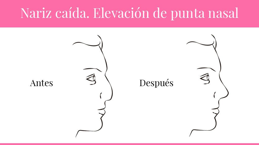 narices-03
