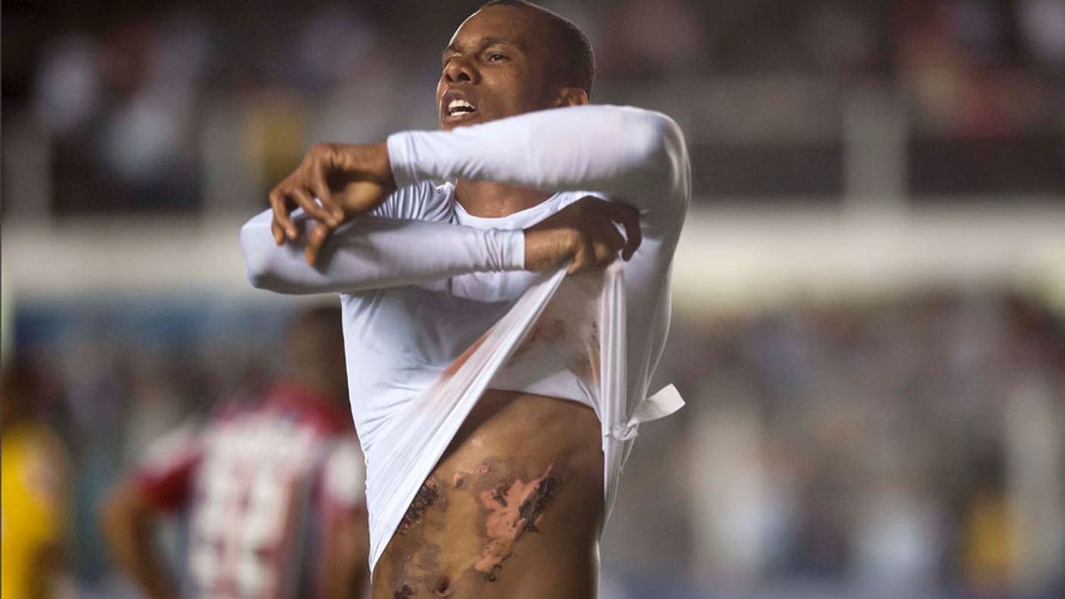 Le explota una olla a presión, juega con quemaduras de tercer grado y marca un hat-trick Le explota una olla a presión, juega con quemaduras de tercer grado y marca un hat-trick