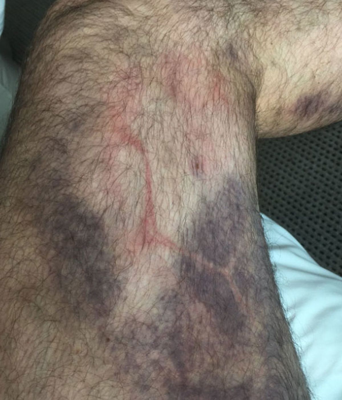 El escocés Don Hutchison terminó con secuelas por la dureza del 'Mundial de Leyendas' El escocés Don Hutchison terminó con secuelas por la dureza del 'Mundial de Leyendas'