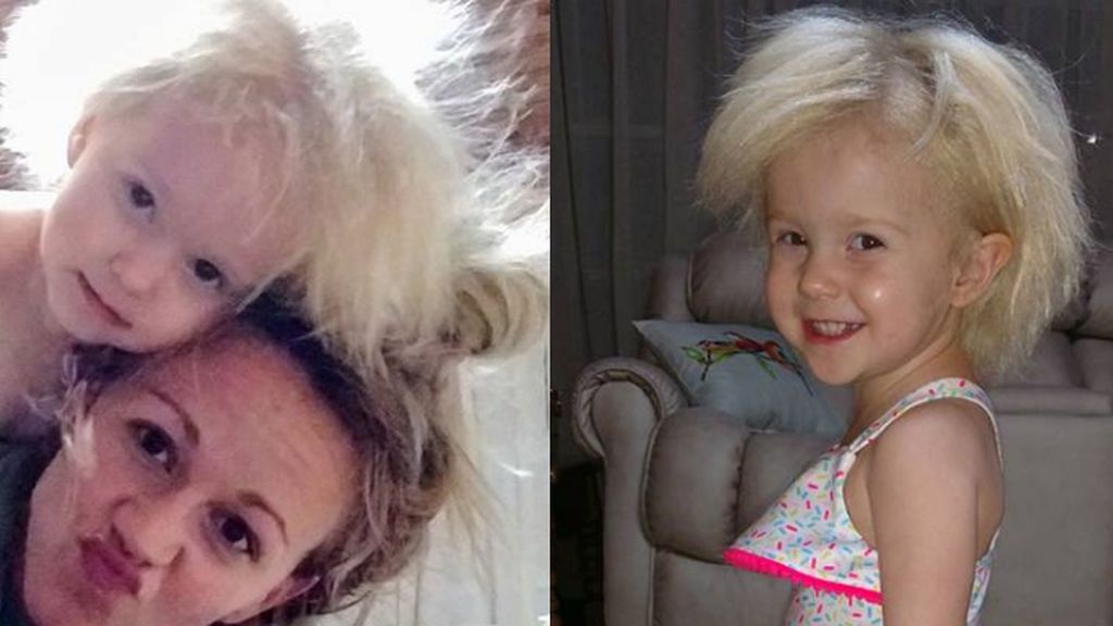 Jaili Lamb, la niña que comparte el mismo síndrome que Albert Einstein Jaili Lamb, la niña que comparte el mismo síndrome que Albert Einstein