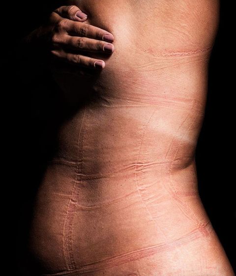 Una campaña brasileña muestra las 'marcas' que deja la ropa en la piel