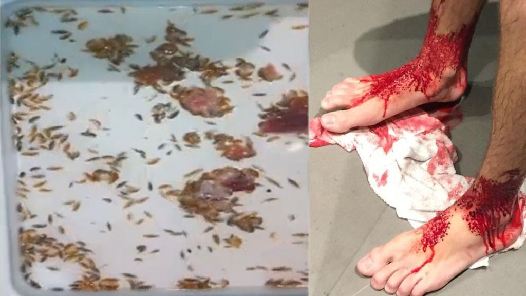 Piojos de mar: Unas criaturas marinas muerden los pies de un adolescente en una playa de Australia