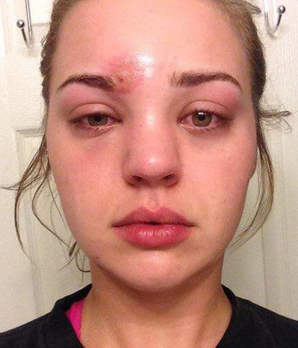 La terrible historia de Katie Wright: Una espinilla casi le cuesta la vida
