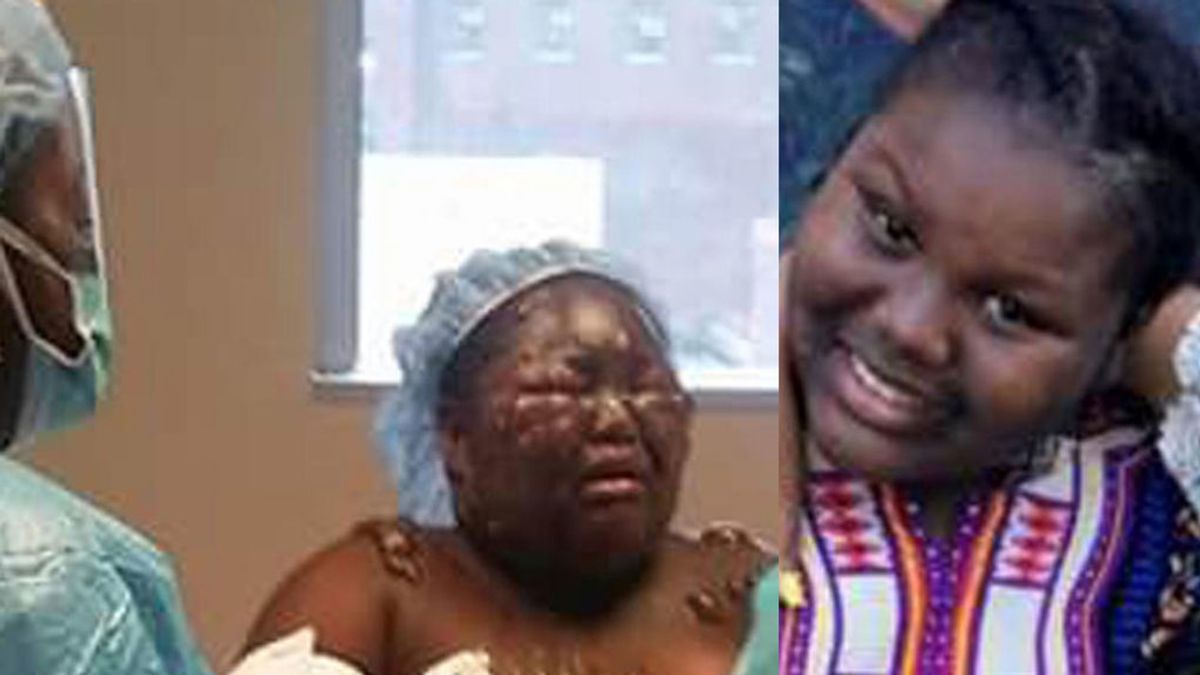 Una niña de 11 años sufre quemaduras en el rostro al echarle agua hirviendo en una  fiesta de pijama